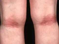 Gambe con arrossamento e ispessimento cutaneo, tipici della dermatite atopica.