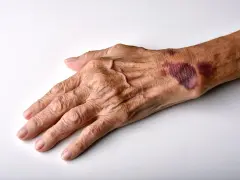 Mano anziana con evidenti segni di atrofia cutanea e lividi sul dorso, pelle sottile e rugosa.
