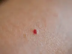 Piccola macchia rossa sulla pelle, tipo bruciatura, che prude.