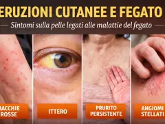 Eruzioni cutanee e ittero, sintomi legati al fegato. Macchie rosse, prurito persistente e angiomi stellati possono indicare problemi epatici.