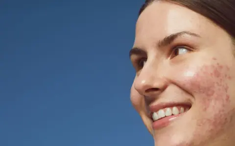 Primo piano di una giovane donna sorridente con pelle imperfetta, dove spicca un brufolo rosso.