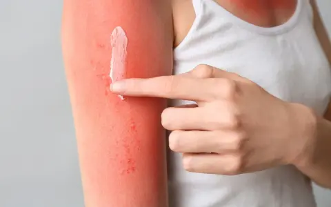 Mano applica crema su braccio arrossato dal sole, cercando rimedi per il prurito dopo abbronzatura.