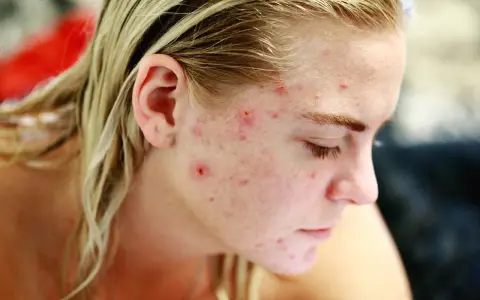 Primo piano del viso di una giovane donna con brufoli in gravidanza, che mostra la pelle arrossata e imperfezioni.