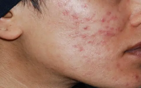 Primo piano del viso di un uomo con evidenti segni di acne ormonale maschile, arrossamenti e pustole sulla guancia e sul mento.