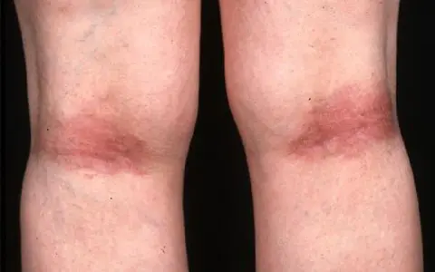 Gambe con arrossamento e ispessimento cutaneo, tipici della dermatite atopica.