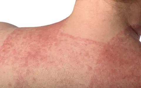 Estesa infiammazione della pelle con arrossamento e piccole pustole sul collo e sulla spalla.