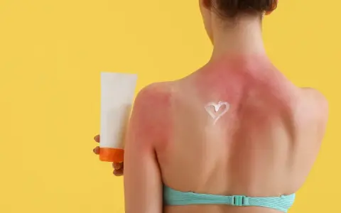 Schiena arrossata e dolente per una scottatura solare. Una crema solare a forma di cuore promette sollievo.