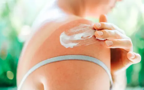 Spalla arrossata dal sole, una mano applica crema solare come crema idratante per lenire la pelle.