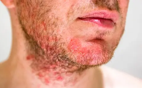 Primo piano di un uomo con dermatite viso, arrossamento e irritazione sulla barba e sul collo.