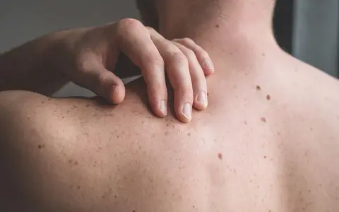 Mano che si gratta la schiena, coperta di nei. Un piccolo brufolo spunta su uno dei nei, un dettaglio inaspettato sulla pelle.