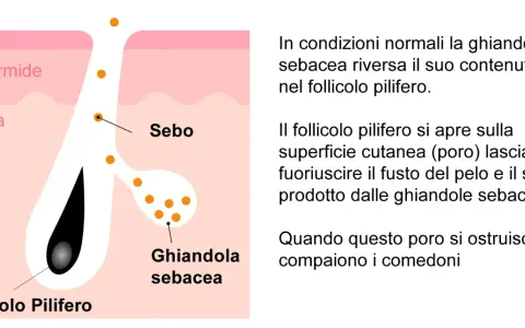 Illustrazione anatomica della pelle che spiega cosa sono i punti neri: il sebo ostruisce il follicolo pilifero.