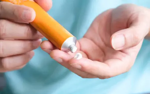 Mano che applica crema al cortisone su un dito, per alleviare la dermatite atopica.