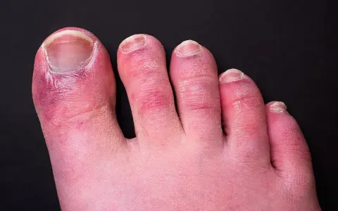 Dita dei piedi arrossate e gonfie, con segni di **geloni ai piedi**. La pelle appare secca e screpolata, soprattutto attorno alle unghie.
