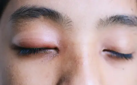 Primo piano di un occhio chiuso con palpebra visibilmente arrossata e gonfia, segno di un occhio gonfio.