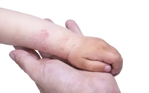 Braccio di bambino con chiazze rosse e squamose, sintomo di dermatite acuta, tenuto da una mano adulta.
