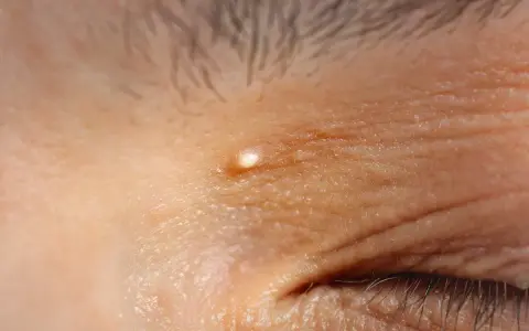 Un piccolo brufolo, simile a grani di miglio, appare sulla pelle rugosa vicino all'occhio.