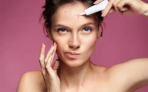 Donna applica crema su un brufolo sulla fronte, preoccupata di quanto dura un brufolo.