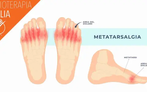 Illustrazione anatomica del piede che mostra la metatarsalgia, un dolore sotto le dita. Rimedi naturali per il dolore sotto le dita del piede.