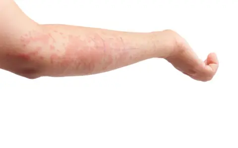 Braccio con eruzione cutanea rossa e pruriginosa, tipica dell'orticaria. Scopri come curarla.