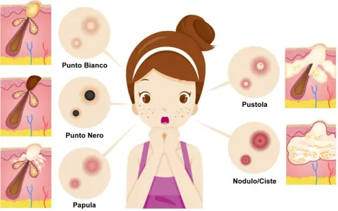 Illustrazione di diversi tipi di imperfezioni cutanee, tra cui un brufolo nero, un punto bianco, una papula, una pustola e un nodulo/cisti.
