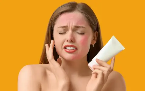 Donna con viso arrossato per eritema solare, che tiene in mano una crema. Potrebbero comparire brufoli a causa dell'irritazione.