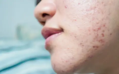 Primo piano del viso di una persona con brufoli pre ciclo, rossori e imperfezioni sulla guancia e sul mento.