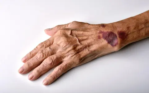 Mano anziana con evidenti segni di atrofia cutanea e lividi sul dorso, pelle sottile e rugosa.