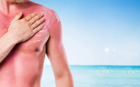 Uomo con forte eritema solare sul petto e spalla, mentre si applica una crema lenitiva. Il mare sullo sfondo ricorda l'estate.