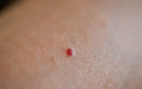 Piccola macchia rossa sulla pelle, tipo bruciatura, che prude.