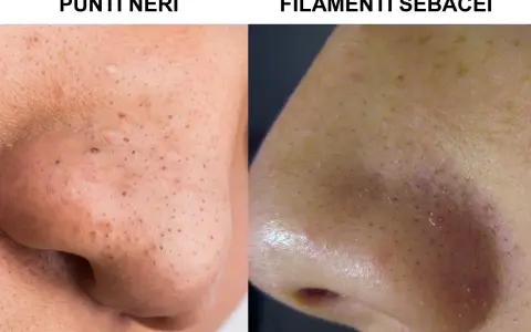 Confronto tra punti neri e filamenti sebacei sul naso. I filamenti sebacei appaiono come piccoli puntini chiari, mentre i punti neri sono più scuri e visibili.