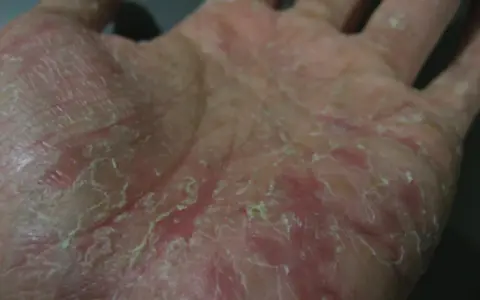 Mano con pelle secca, screpolata e arrossata, sintomo di disidrosi mani.