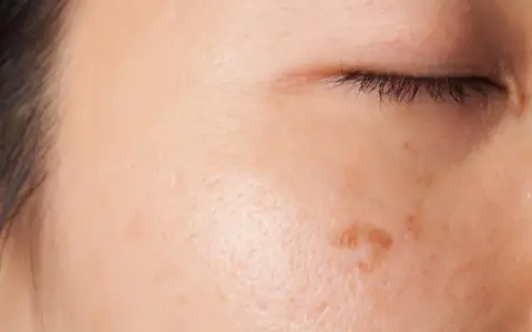 Primo piano del viso con imperfezioni e macchie che evidenziano la pigmentazione pelle.
