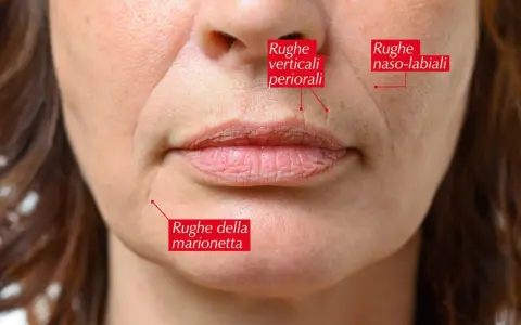 Primo piano del volto di una donna che mostra cosa sono le rughe: naso-labiali, verticali periorali e della marionetta.