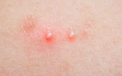 Due pustole sul corpo, rosse e gonfie, con la punta bianca, circondate da peluria sottile.