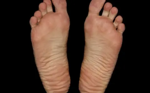 Piante dei piedi con evidenti calli e rughe, segno di lunghe camminate.