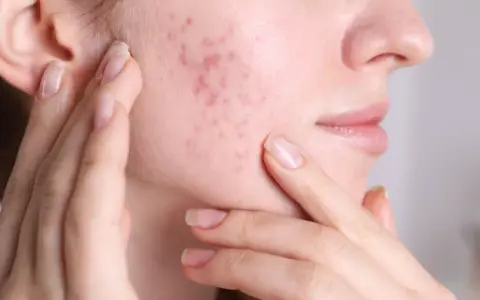 Primo piano del viso di una donna con brufoli sul viso, che si tocca la guancia. Capire perchè vengono i brufoli è il primo passo per una pelle sana.