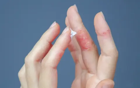 Mani con dermatite dita: pelle arrossata, screpolata e con piccole lesioni. Una mano applica crema.