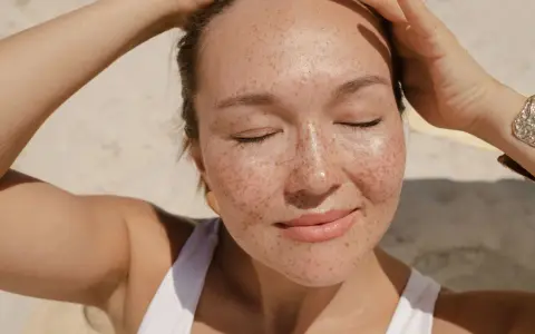 Donna con lentiggini al sole, con le mani tra i capelli. Forse la crema solare tutti i giorni fa male?