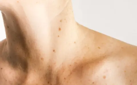 Pelle chiara con numerose macchie solari e lentiggini sul collo e sulle spalle. Alcune macchie solari vanno via da sole, altre rimangono.