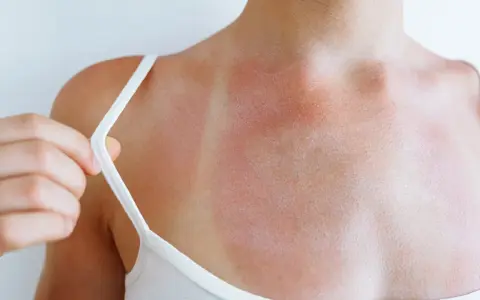 Spalla arrossata e irritata, con segni evidenti di eritema solare prurito. La pelle è segnata dal sole.