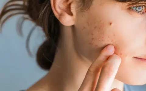 Primo piano del viso di una giovane donna con macchie da acne, che indica come togliere le macchie da acne.