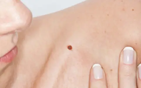 Primo piano di una spalla con un neo rosso sulla pelle. Dita con unghie curate sfiorano delicatamente la cute.