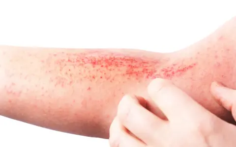Braccio con eruzione cutanea rossa e puntini, possibile micosi dermatite da stress senza prurito.