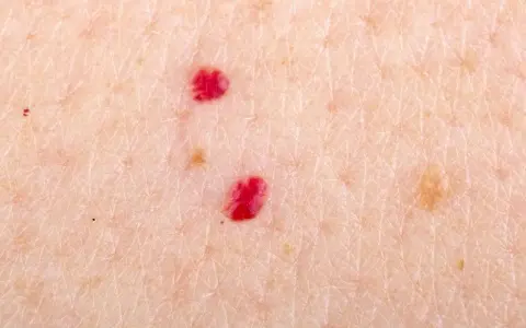 Primo piano della pelle con due angiomi rubino. Si cercano angioma rubino rimedi naturali per attenuare queste piccole macchie rosse.