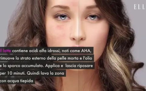 Scopri come togliere i brufoli dal viso con il latte, ricco di AHA che esfoliano e puliscono la pelle.
