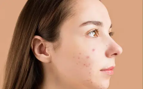 Primo piano del viso di una giovane donna con brufoli. La domanda "quanto ci mette un brufolo ad andare via" è centrale per chi soffre di acne.