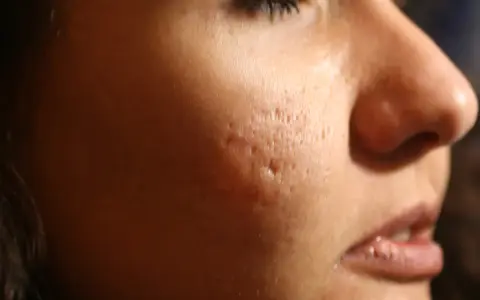 Primo piano del viso di una persona con evidenti cicatrici da acne, simili a macchie varicella, sulla guancia.