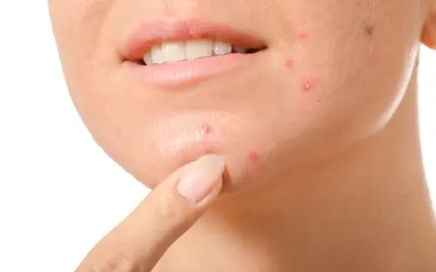 Dito, come non schiacciare i brufoli: un dito indica un brufolo sul viso, vicino alla bocca.