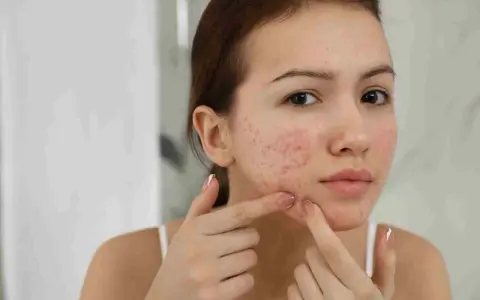 Viso di giovane donna con rossori e brufoli, un segno comune di acne in gravidanza.