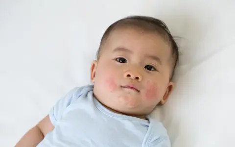 Bambino con guance arrossate e screpolate, forse per la differenza tra dermatite atopica e seborroica.